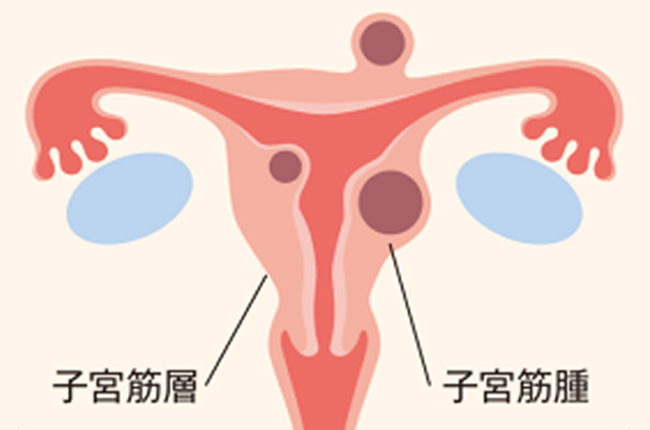 子宮筋腫
